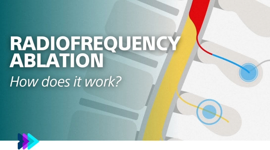I det här videoklippet beskrivs radiofrekvensablation och några av dess fördelar.